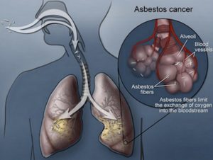 causes-of-asbestos-lung-cancer